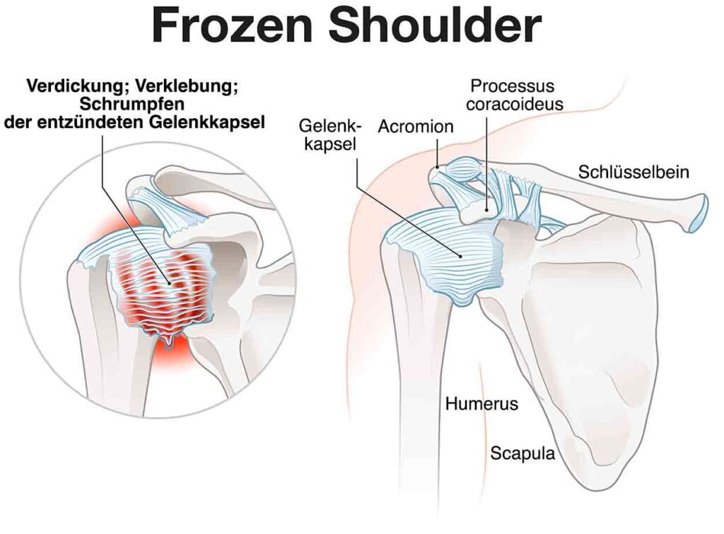 Grafik Frozen Shoulder